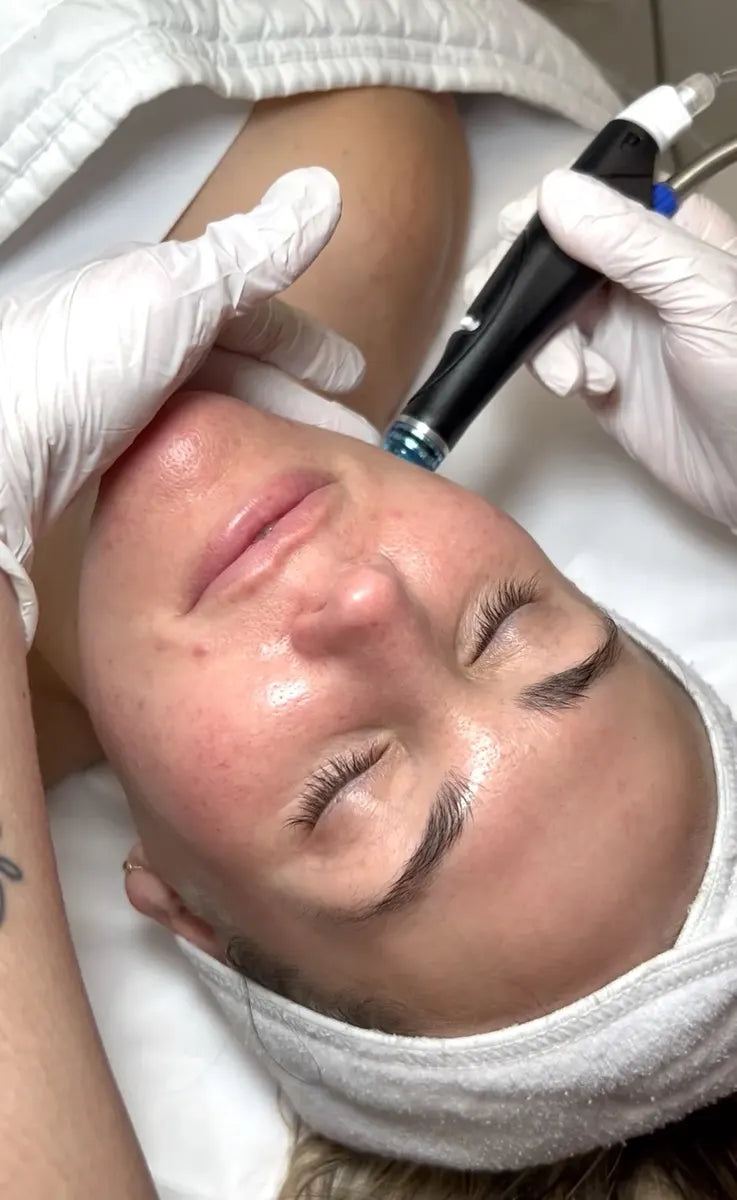 Hydrafacial treatment on the face in Bradenton, FL