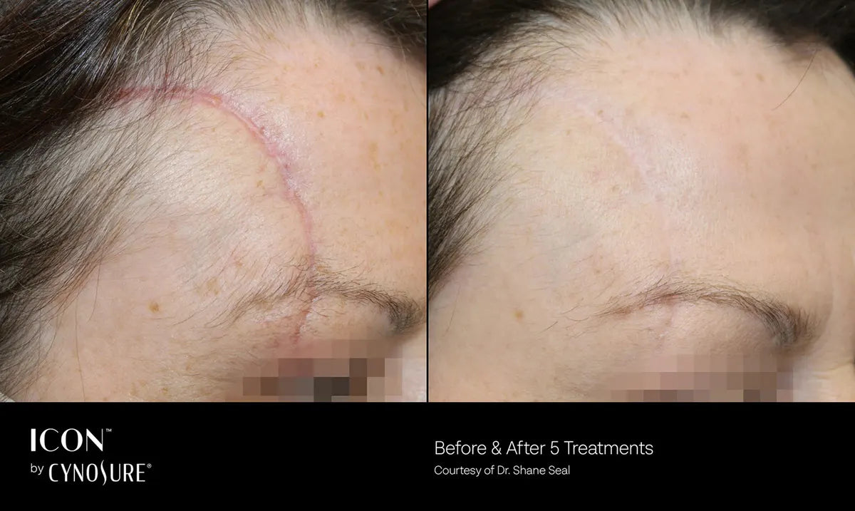 Before and after Icon fractional laser on a scar