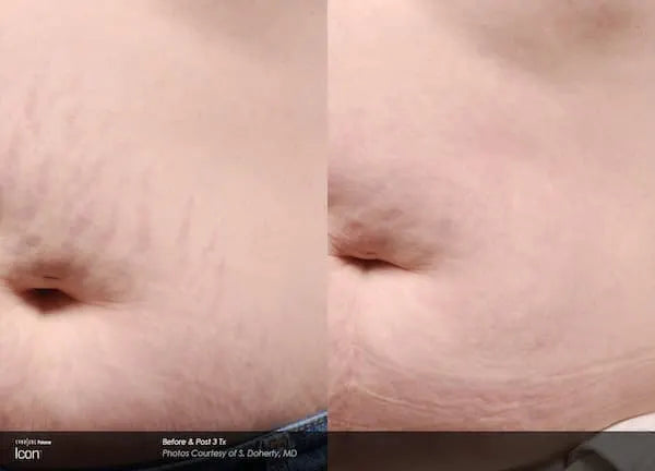 Before and after Icon fractional laser on stretch marks