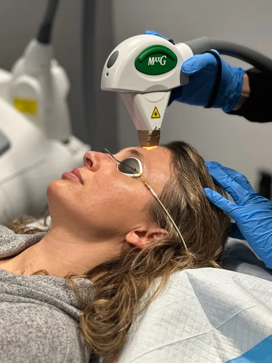 IPL photofacial treatment on the face with protective eyewear in Bradenton, FL
