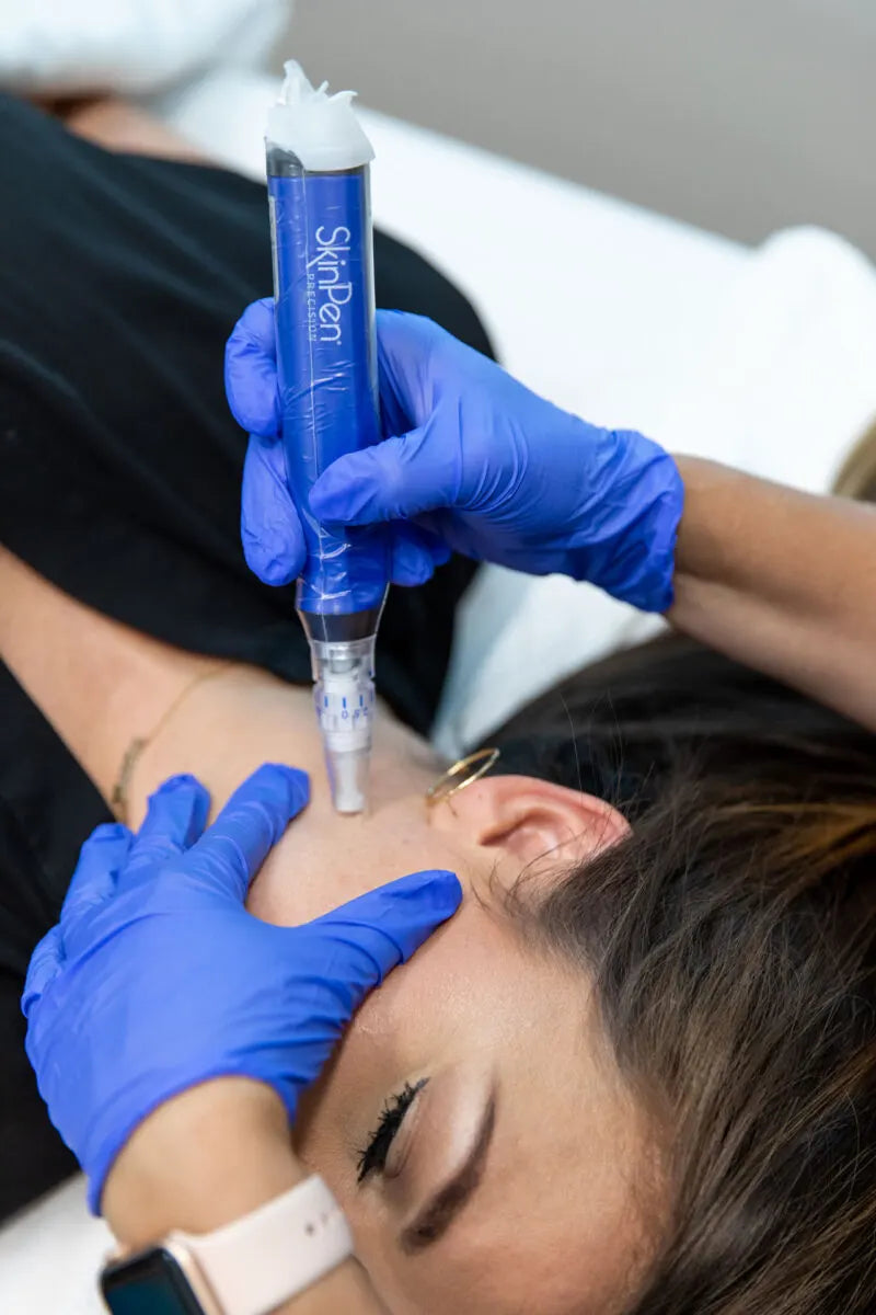 SkinPen microneedling on the cheek