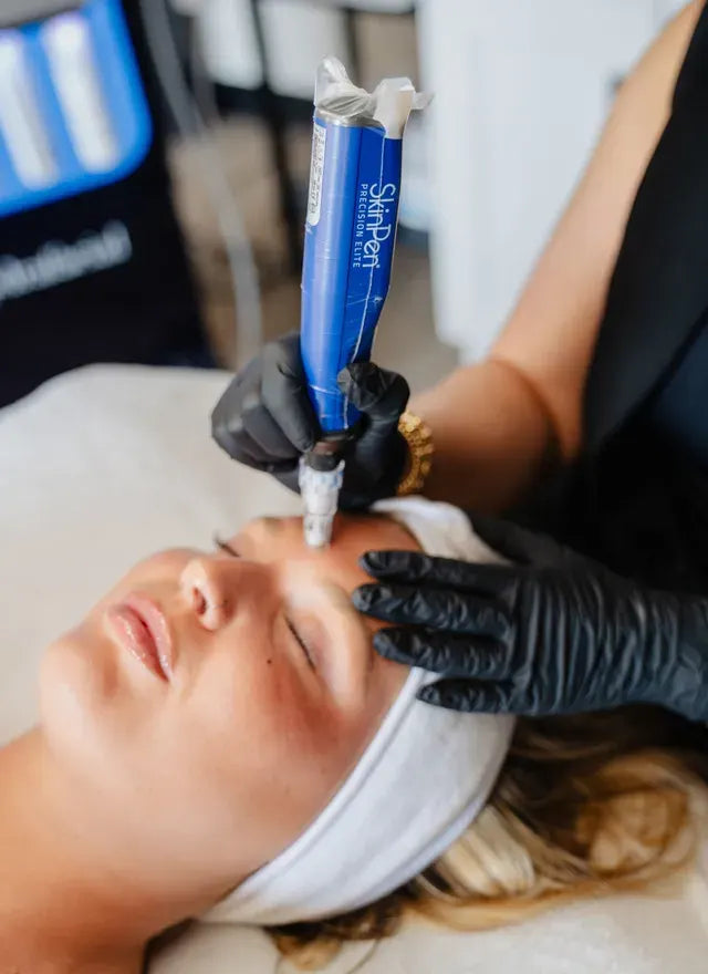 SkinPen microneedling on the forehead