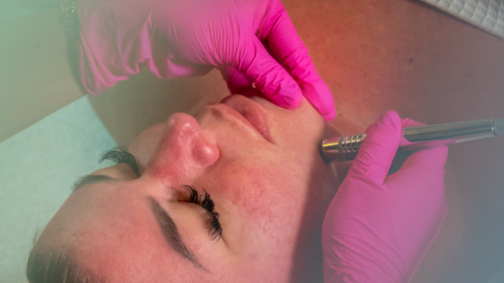 Why Choose Microneedling in Bradenton