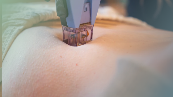 Why Bradenton Loves Laser Stretch Mark Treatments