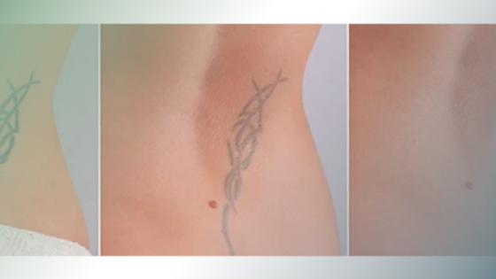 Tattoo Removal in Lakewood Ranch