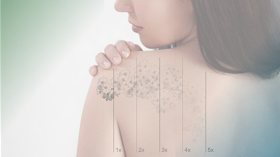 Everything You Need to Know About Laser Tattoo Removal