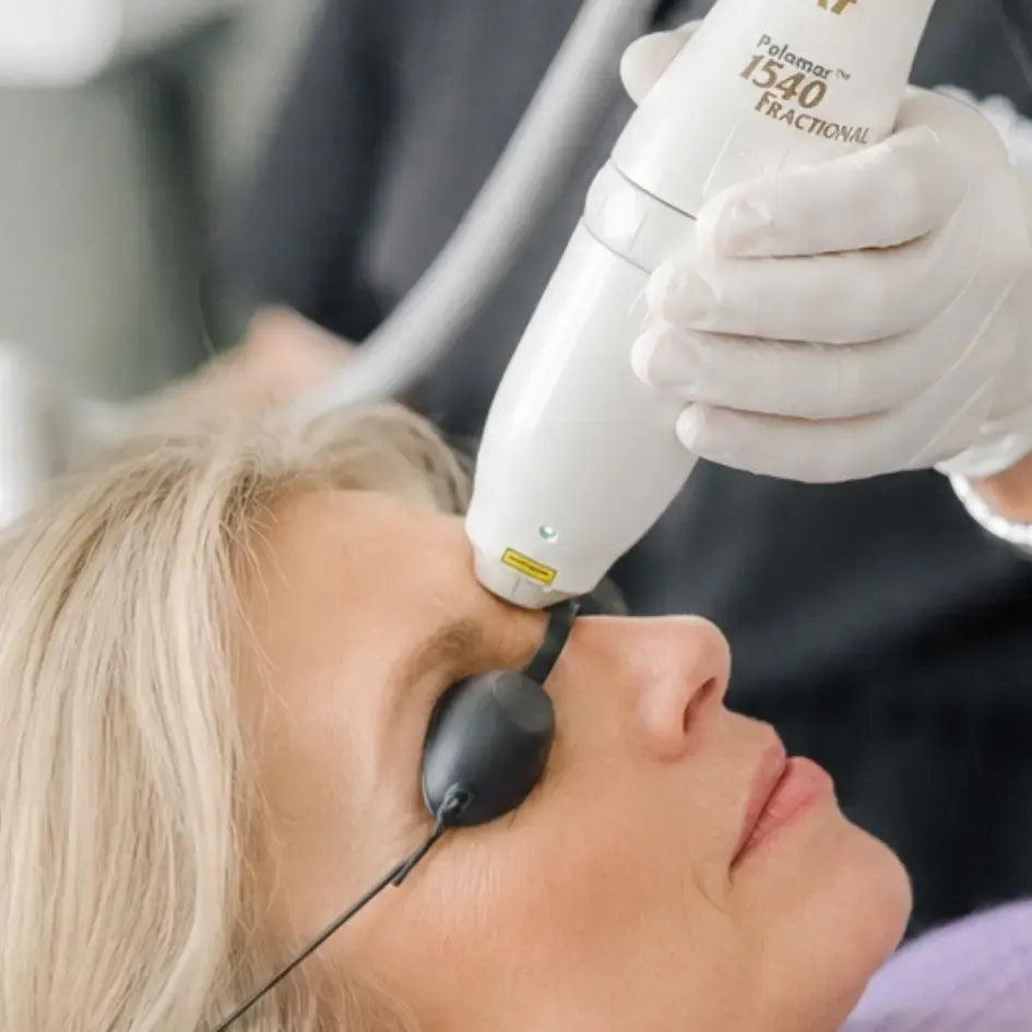 Icon 1540 fractional laser treatment on the face in Bradenton, FL